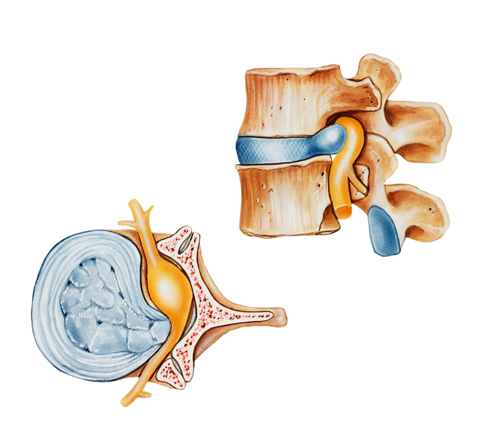 intervertebral discs